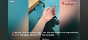 Paralysie du bras gauche causée par des dommages nerveux après la pose d'un implant contraceptif.