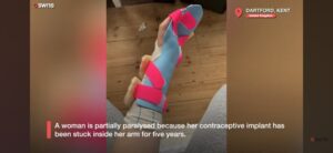 Une femme souffrant de paralysie partielle due à un implant contraceptif resté coincé pendant cinq ans.