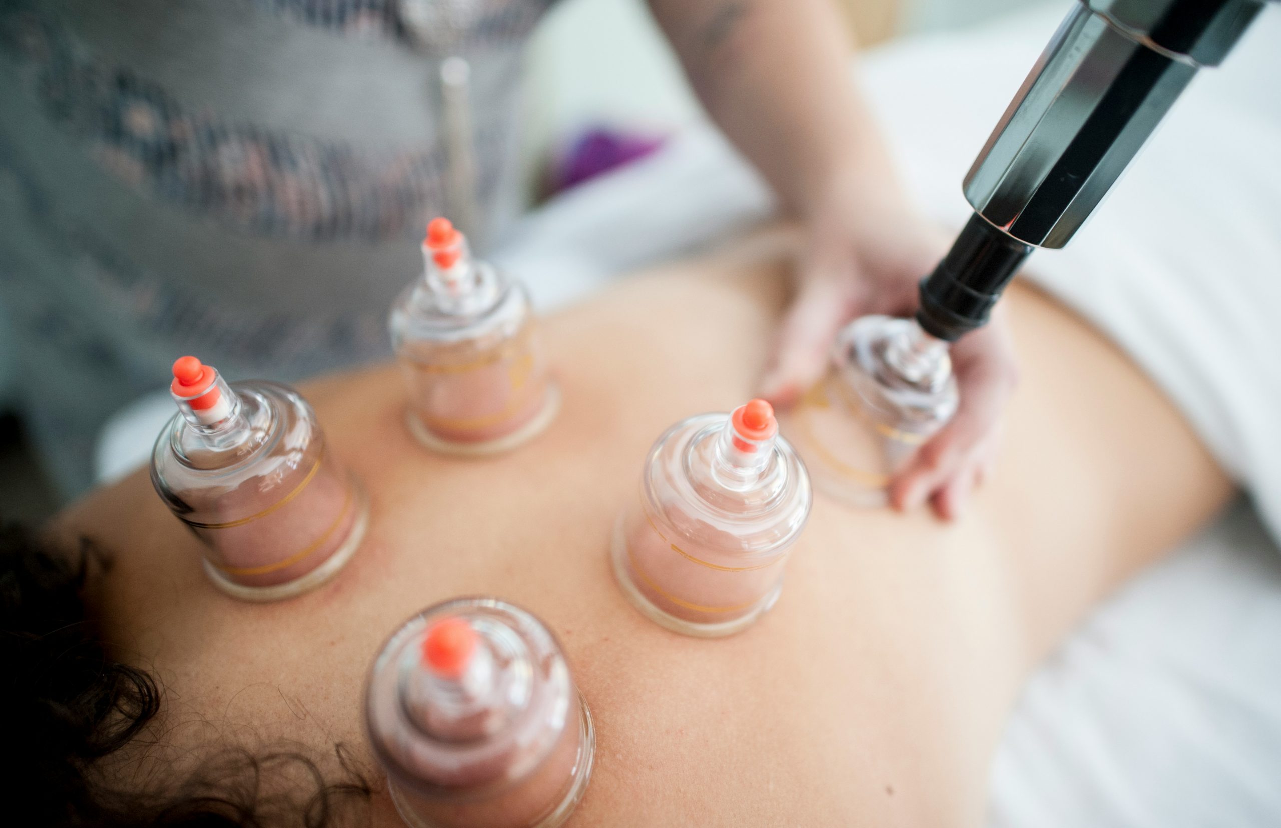 Photo montrant une séance de ventouses médicales utilisées pour le massage et la thérapie, un remède naturel pour apaiser les douleurs et favoriser la relaxation.