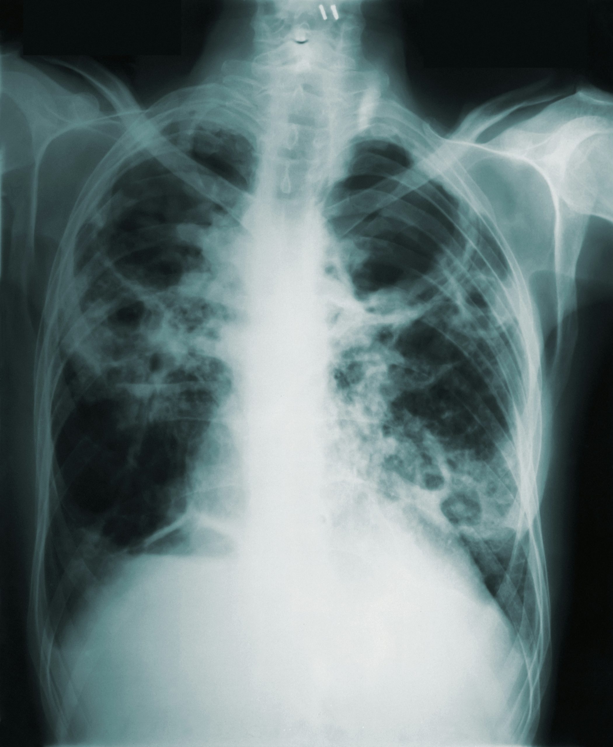 Radiographie des poumons d’un patient atteint de tuberculose, présentant des lésions pulmonaires étendues.